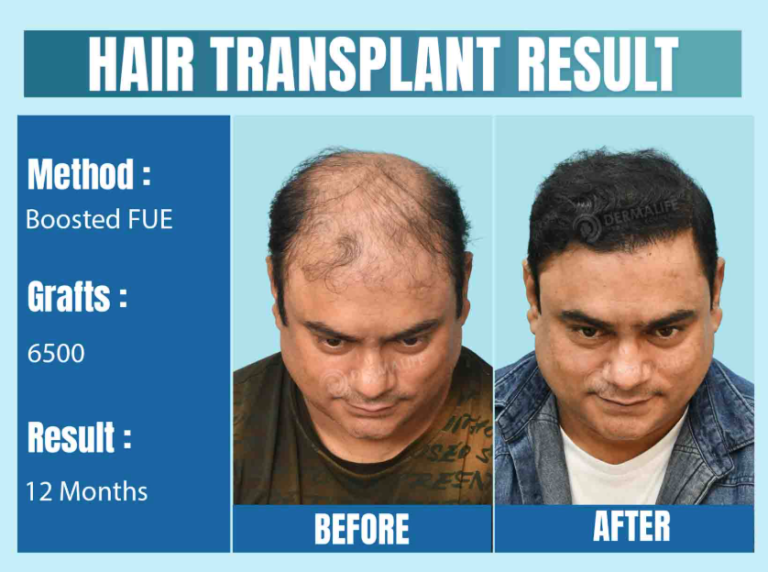Cost of Hair Transplant in Delhi: Invest in Quality, Not Just Cost